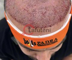 Best Hair Transplant In UAE With Low Cost - Image 1